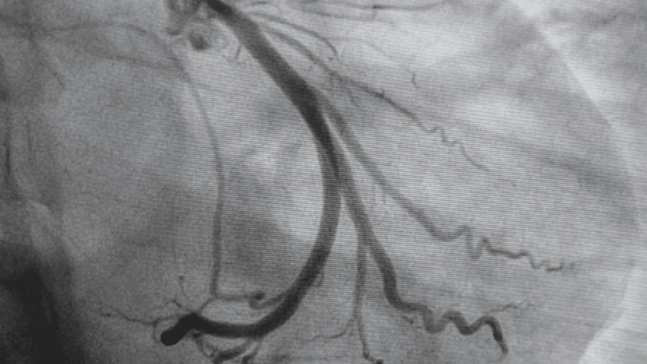 Angiogram Pinnacle Vein and Vascular Center AZ