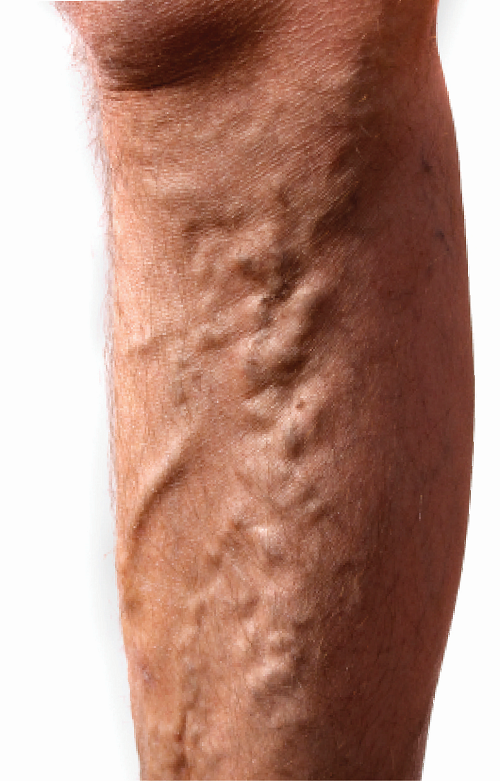 Varicose Veins doctor