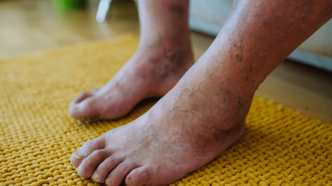 Diabetic Foot Care Tips for Healthy Feet and Veins