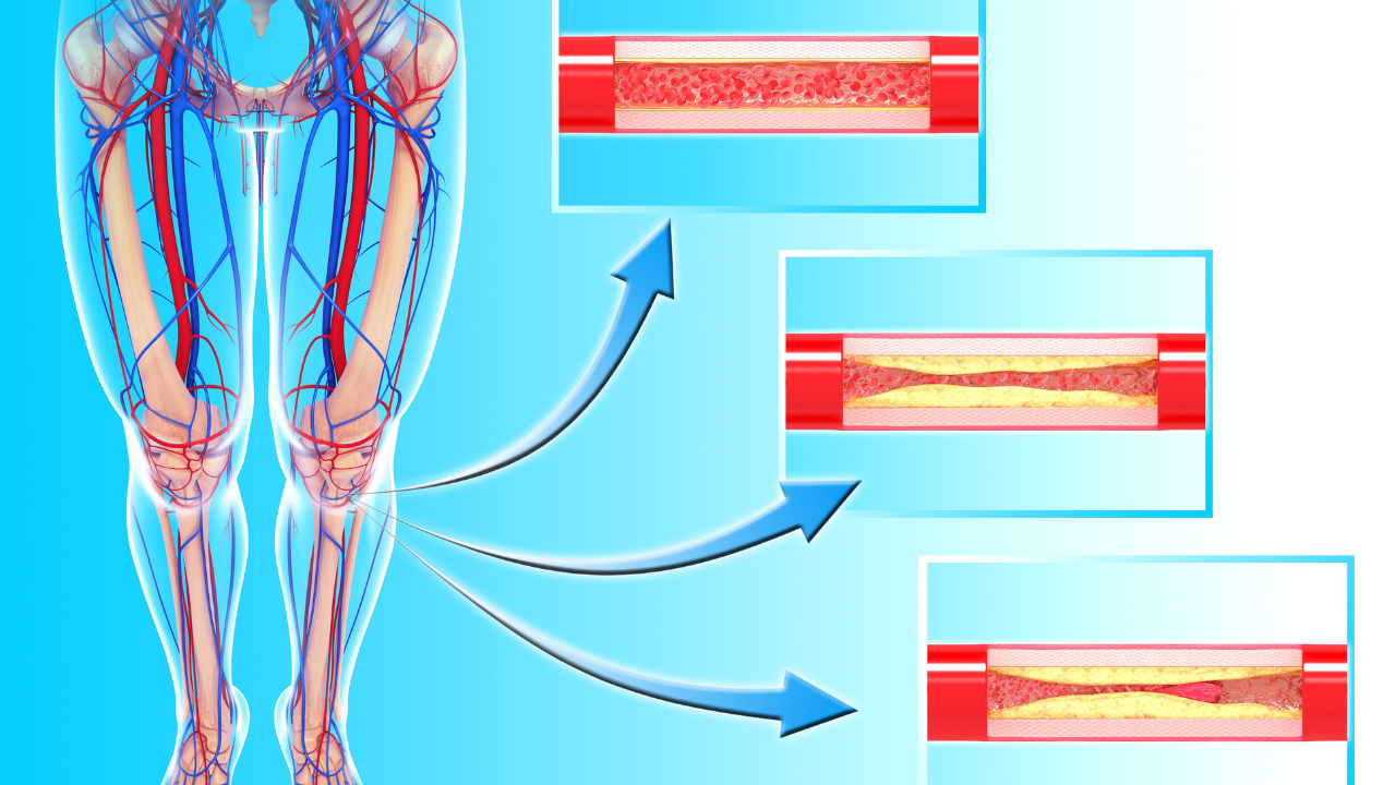Peripheral Artery Disease PAD Pinnacle Vein