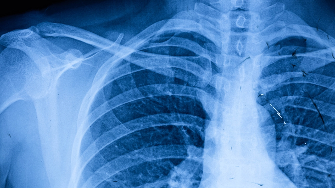 Thoracic Outlet Syndrome vein center in arizona