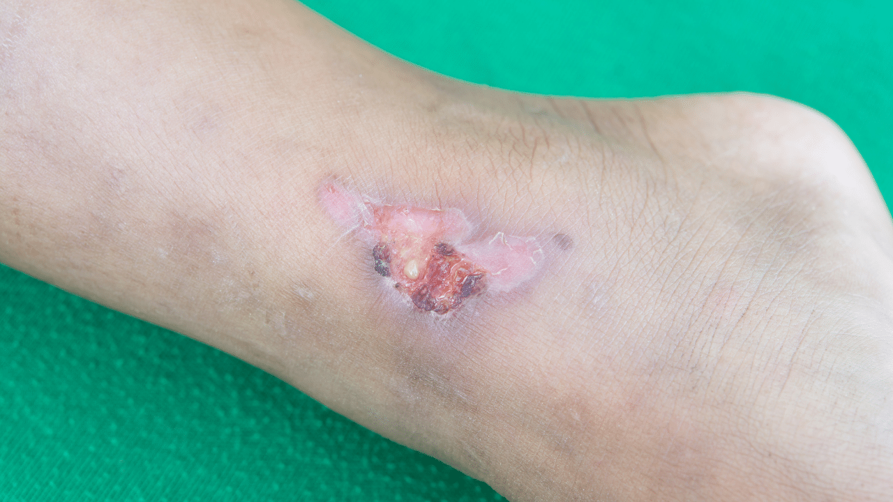 Understanding Venous Stasis Ulcers and Prevention