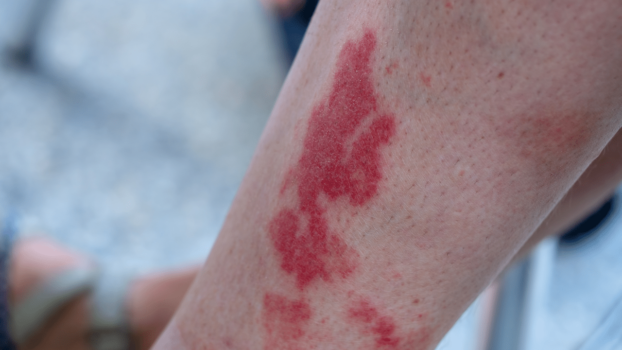 Vasculitis Dr. Brown Pinnacle Vein AZ