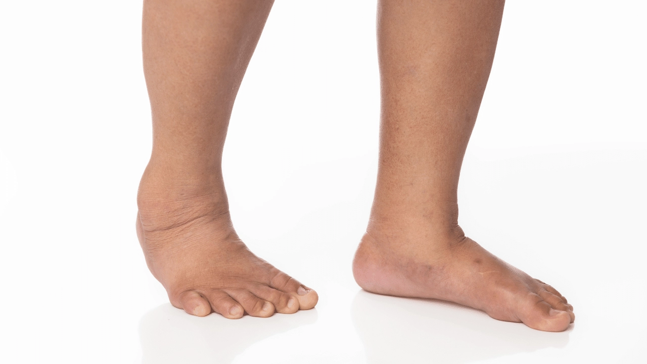 When Leg Swelling Could Be a Sign of Venous Insufficiency dr baljeet uppal