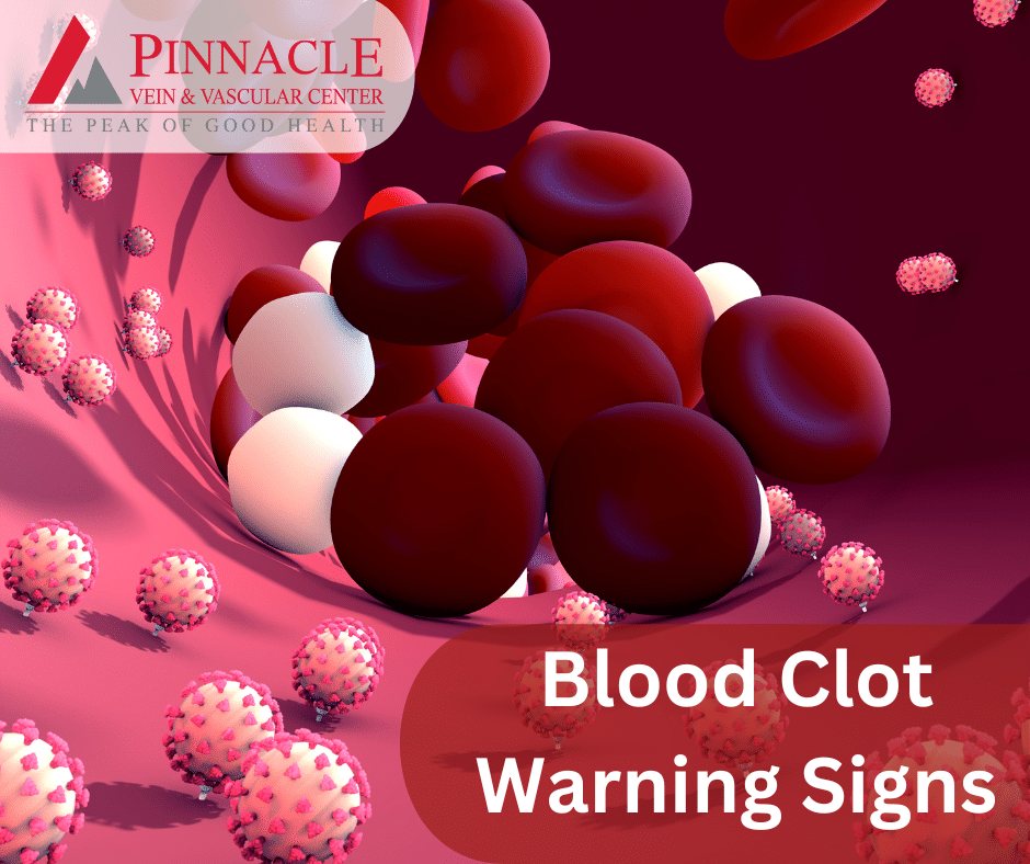 blood clot signs of dvt vein care