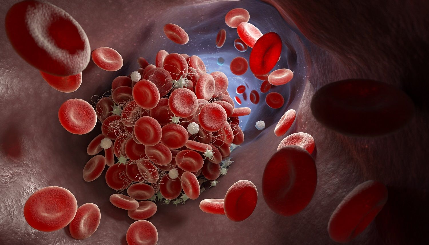 blood-clot-vein-center-gilbert-az
