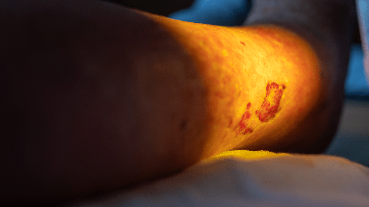 leg ulcers pinnacle vein care avondale az