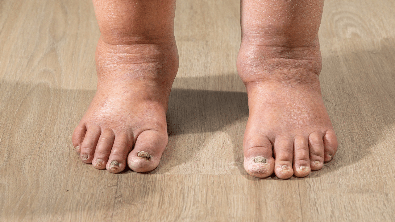 lymphedema swollen legs vascular surgeons