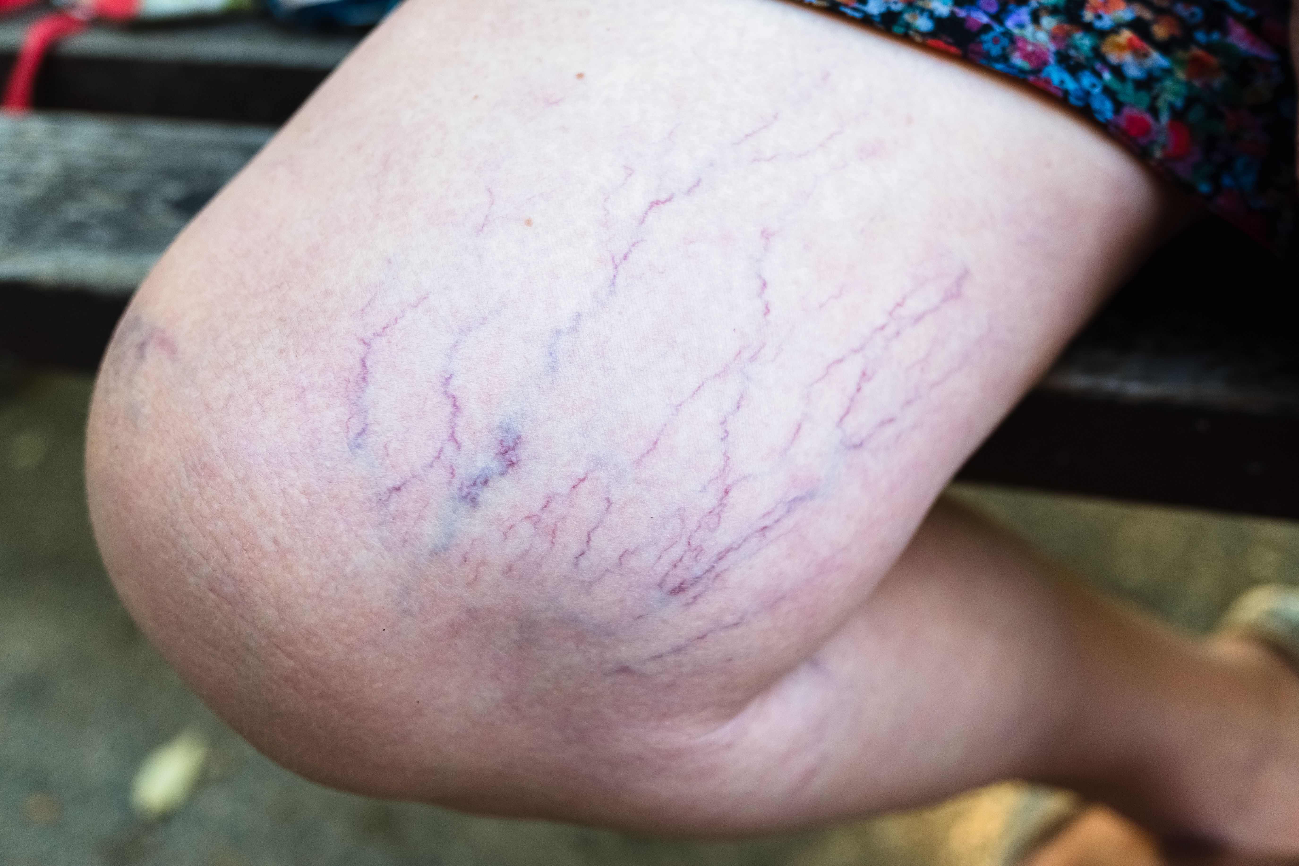 spider-vein-symptoms-pinnacle-vein-center-sun-city-phoenix