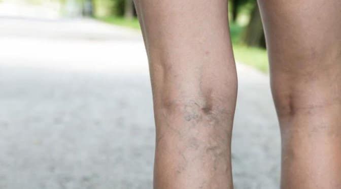 spider veins surprise az scottsdale az mesa az