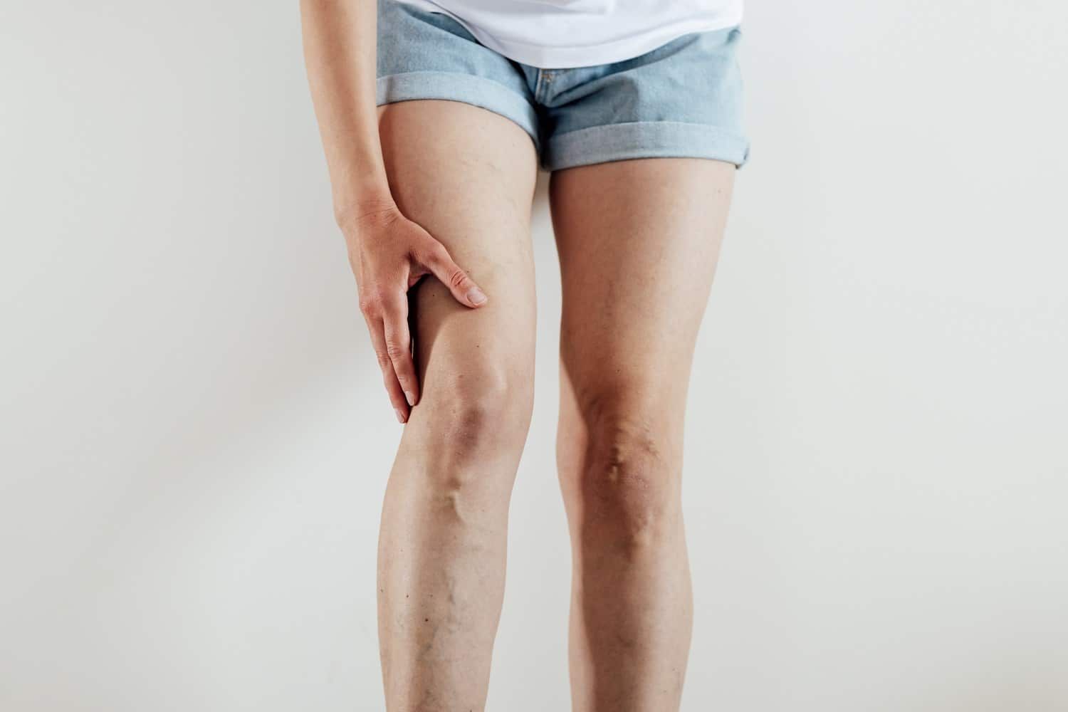 spider-veins-dr-surprise-az