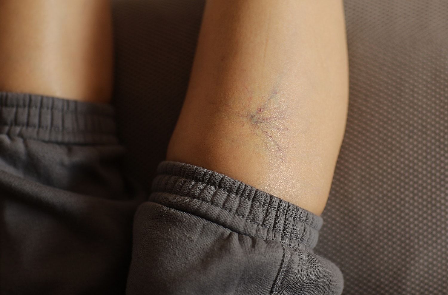 Painful varicose and spider veins on womans legs, who is active at home. Two active seniors in the background. Vascular disease, varicose veins problems, active life concept.