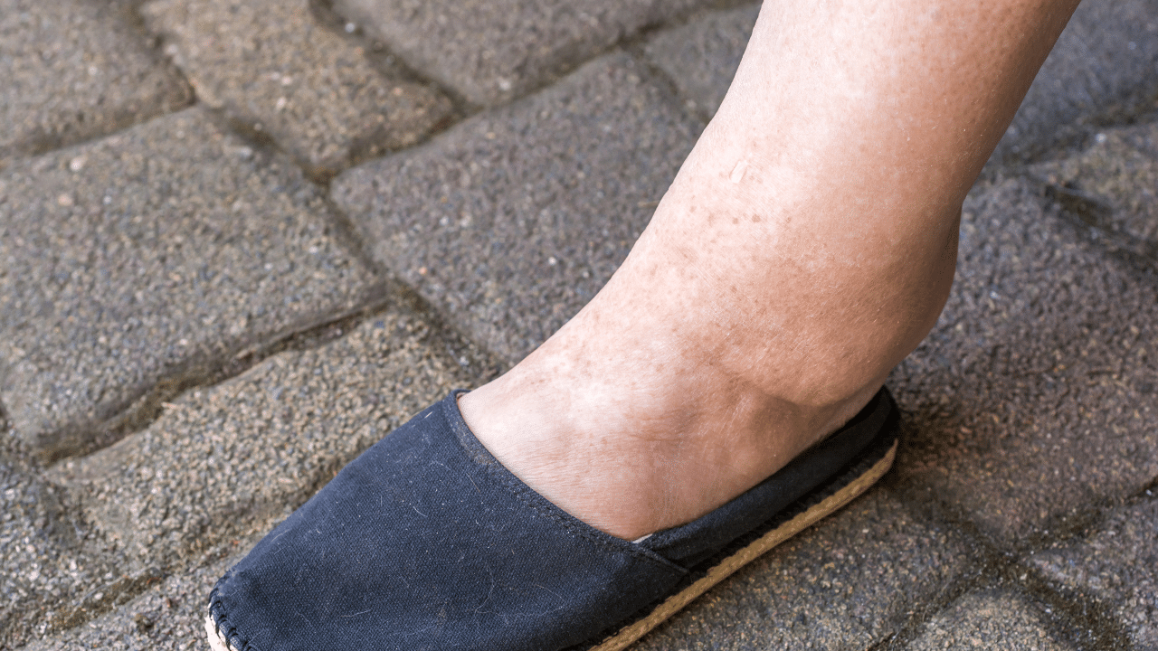 swollen ankles pinnacle
