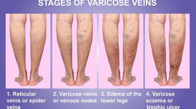 varicose veins surprise mesa AZ