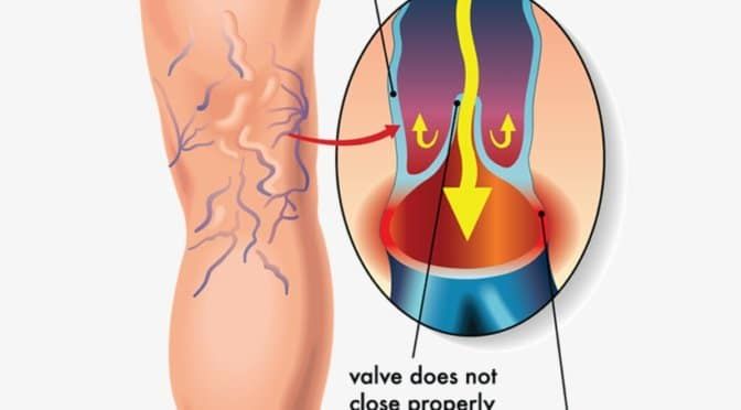 varicose veins scottsdale