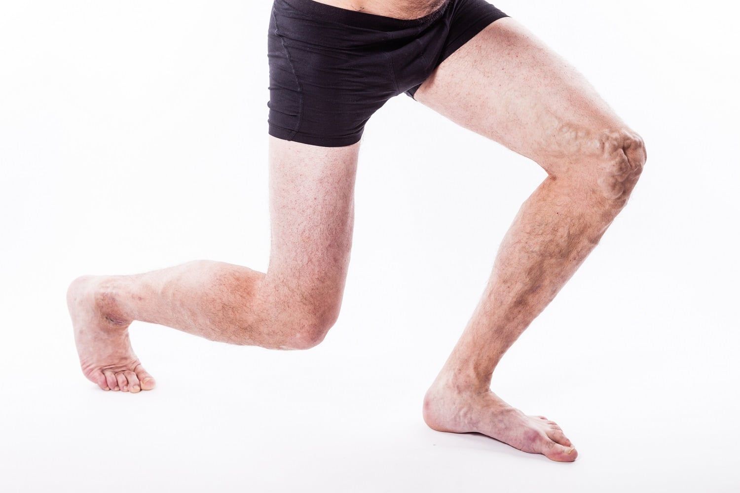 varicose veins vein issues vein center pinnacle
