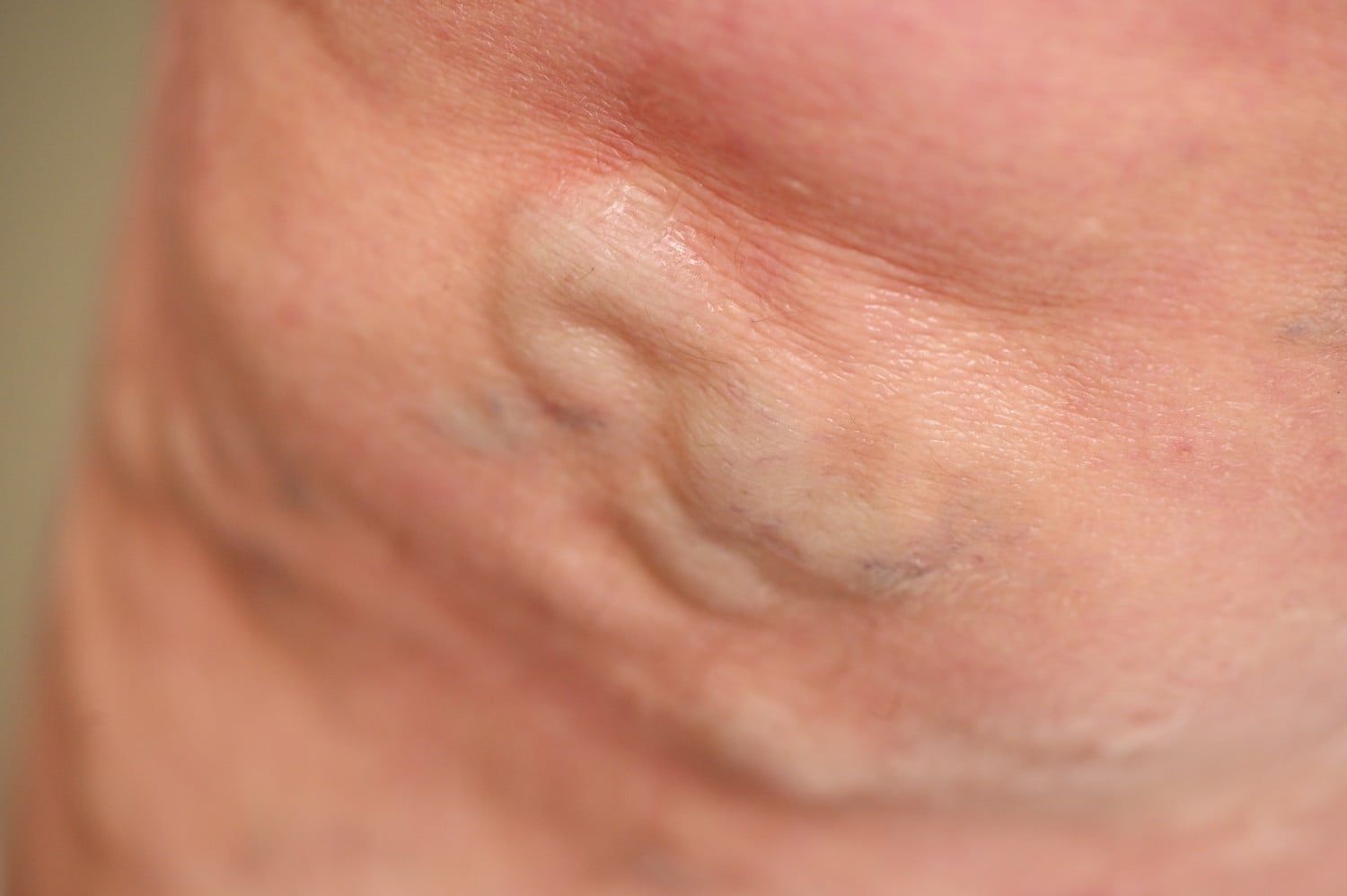 varicose-veins-vein-surgeon-surprise