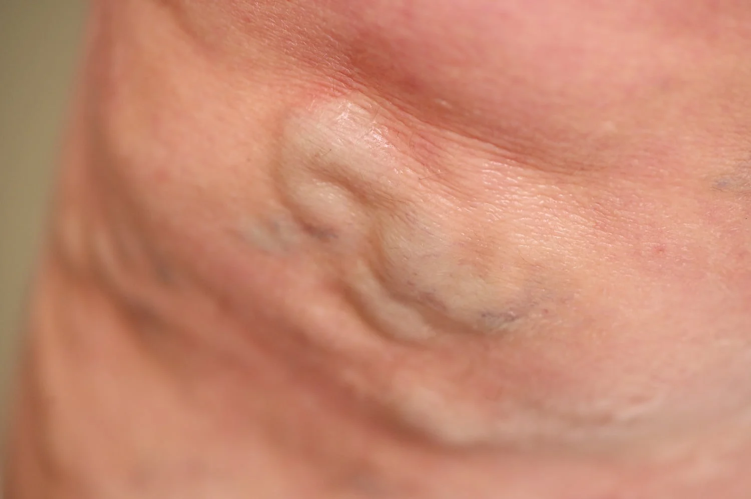 varicose-veins-vein-surgeon-surprise