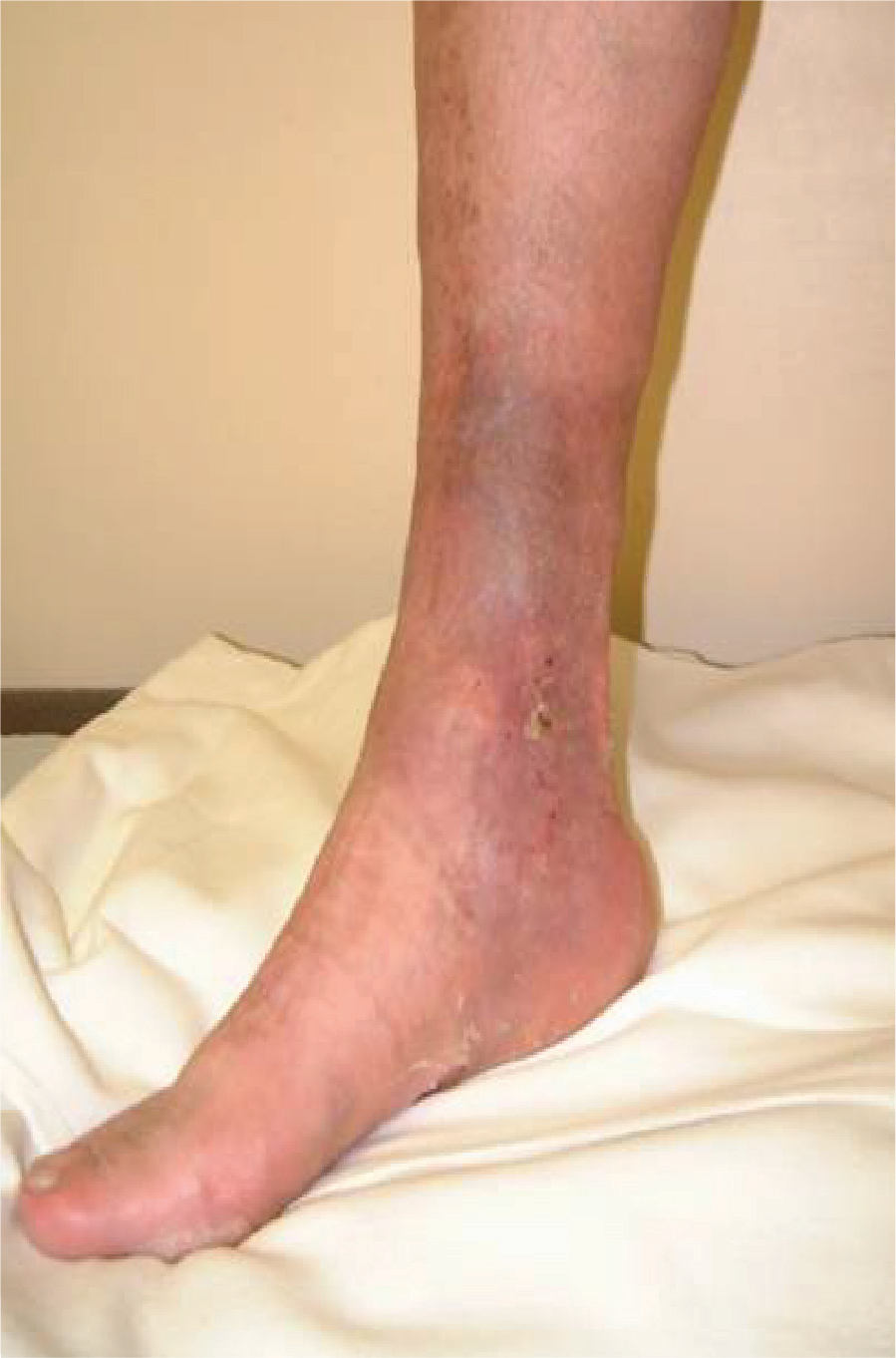 vein ligation pinnacle vein and vascular center