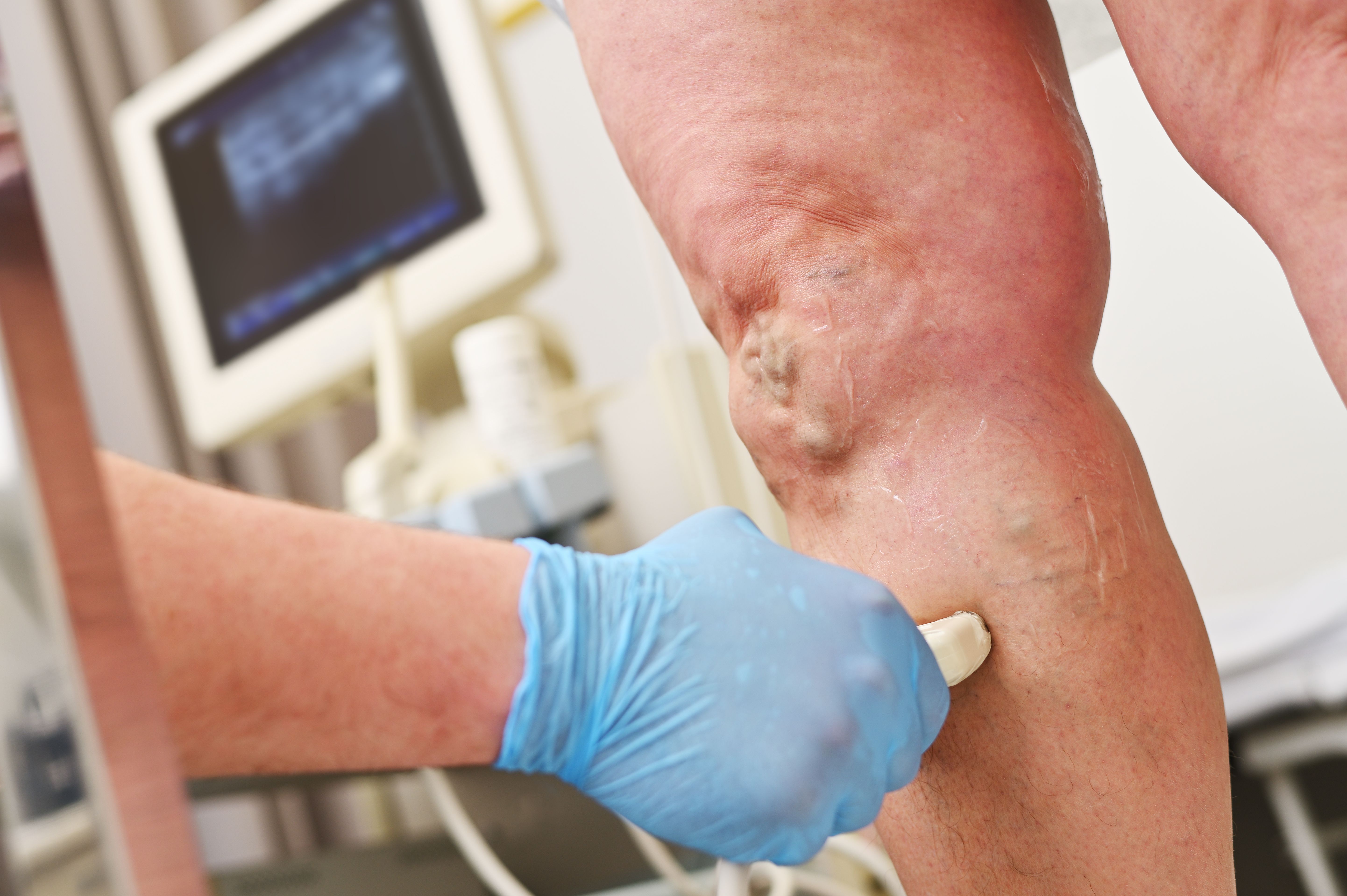 vein ultrasound surprise gilbert