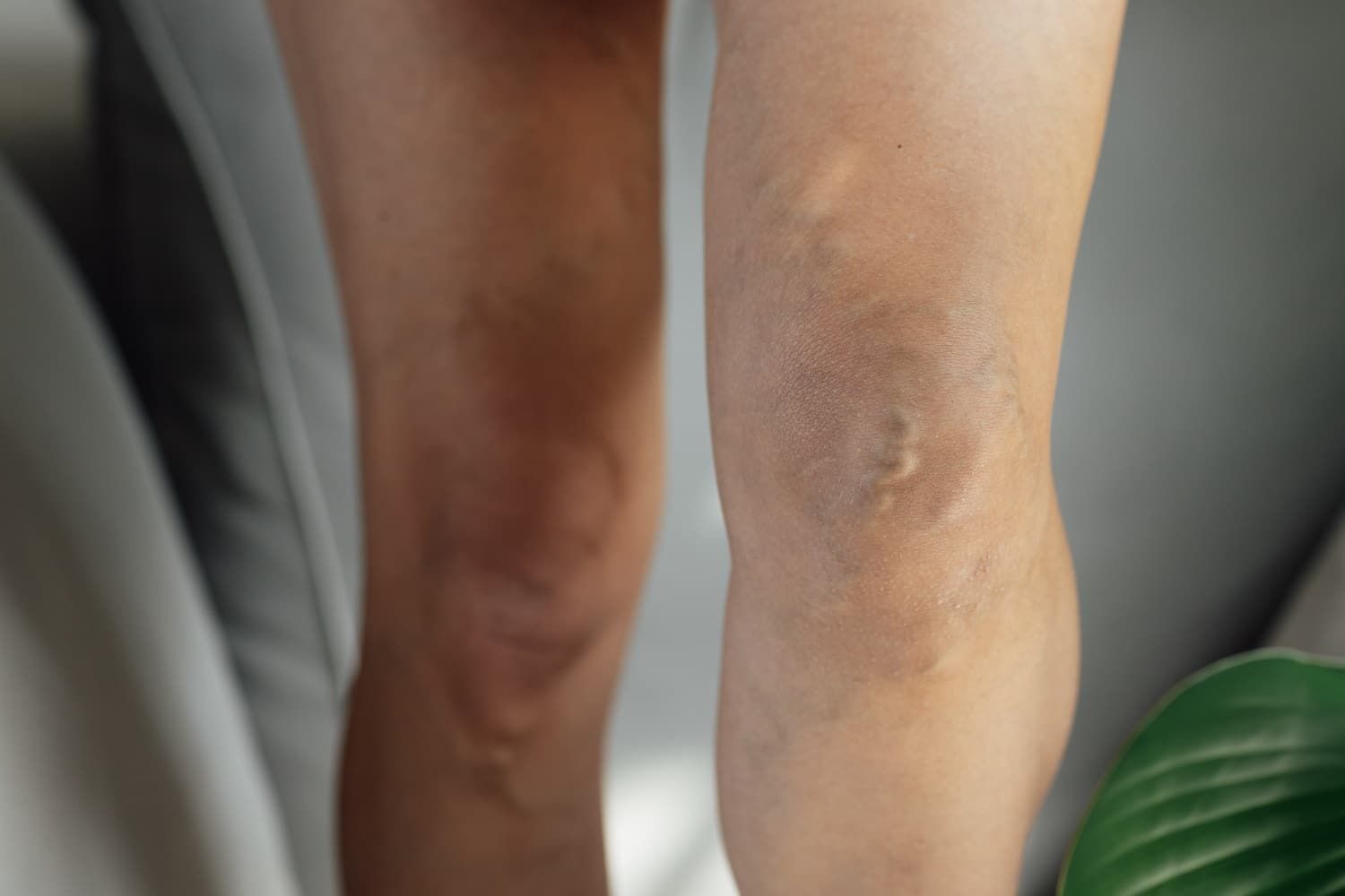veins pinnacle vein and vascular uppal vein surgeon
