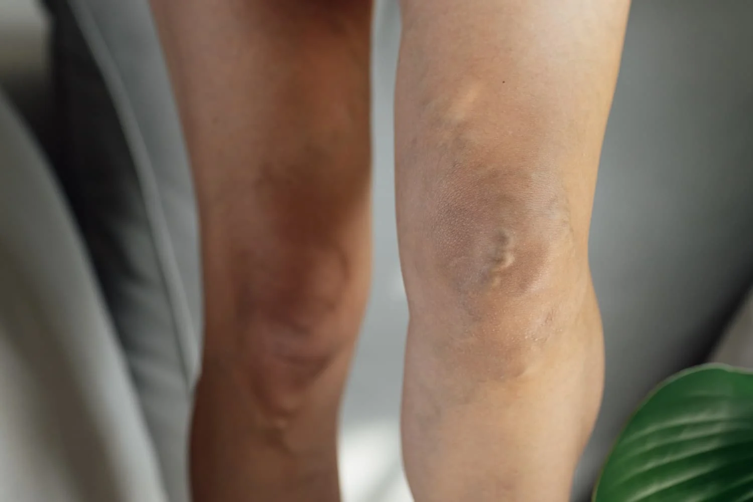 veins pinnacle vein and vascular uppal vein surgeon
