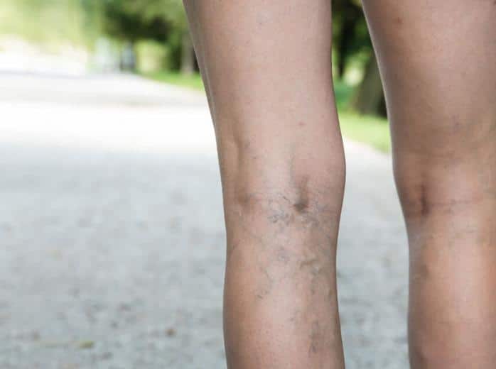 Spider veins surprise scottsdale mesa AZ