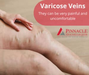 varicose-vein-symptoms-to-look-out-for