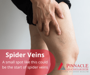 spider-veins-start-pinnacle-vein-venous-insufficiency